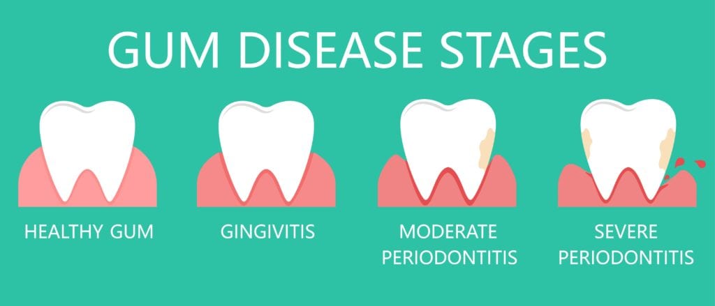 Gum Disease Stages, TN