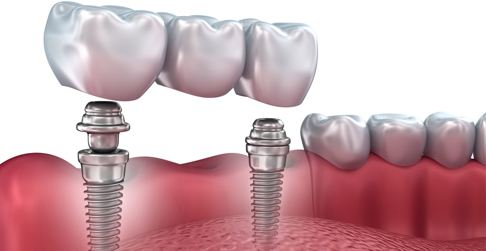 Implant-Supported Dentures Procedure