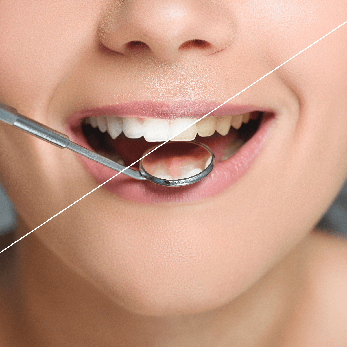 The Many Benefits of Professional Teeth Whitening