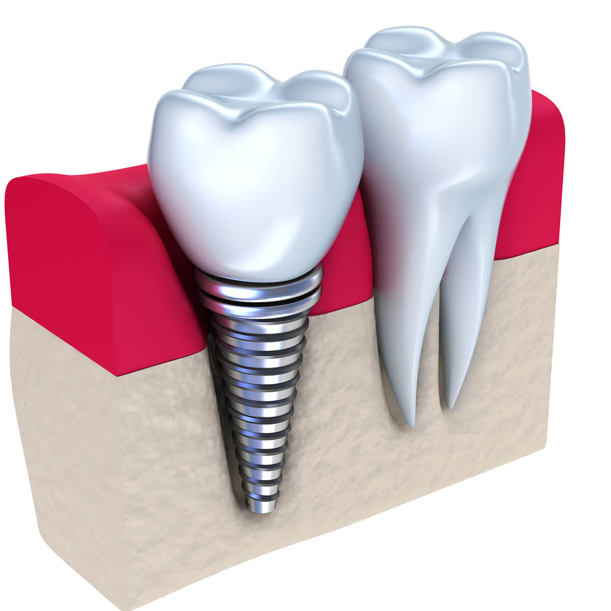 Cost of Dental Implants in Knoxville Area