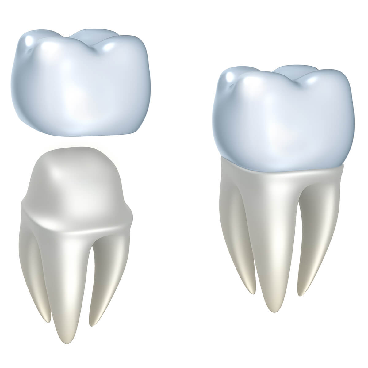 Reasons why a dentist might recommend dental crowns