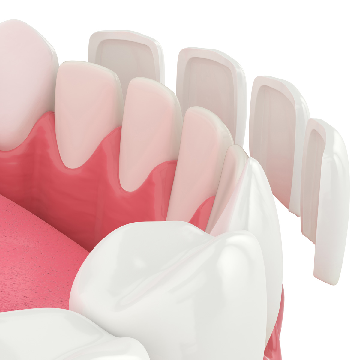 Find Out More About Porcelain Veneers Near Me in Knoxville, TN