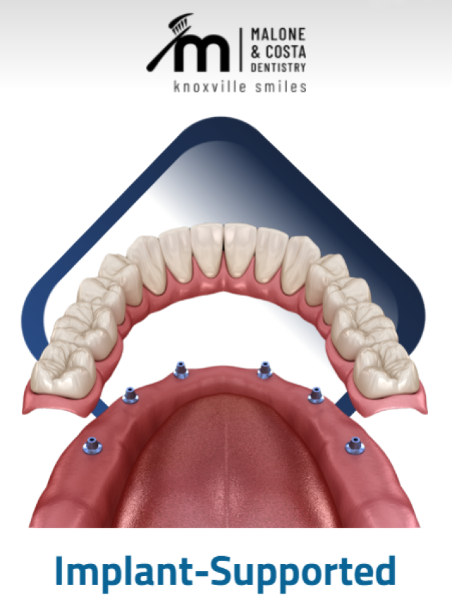 Smile with Implant-Supported Dentures