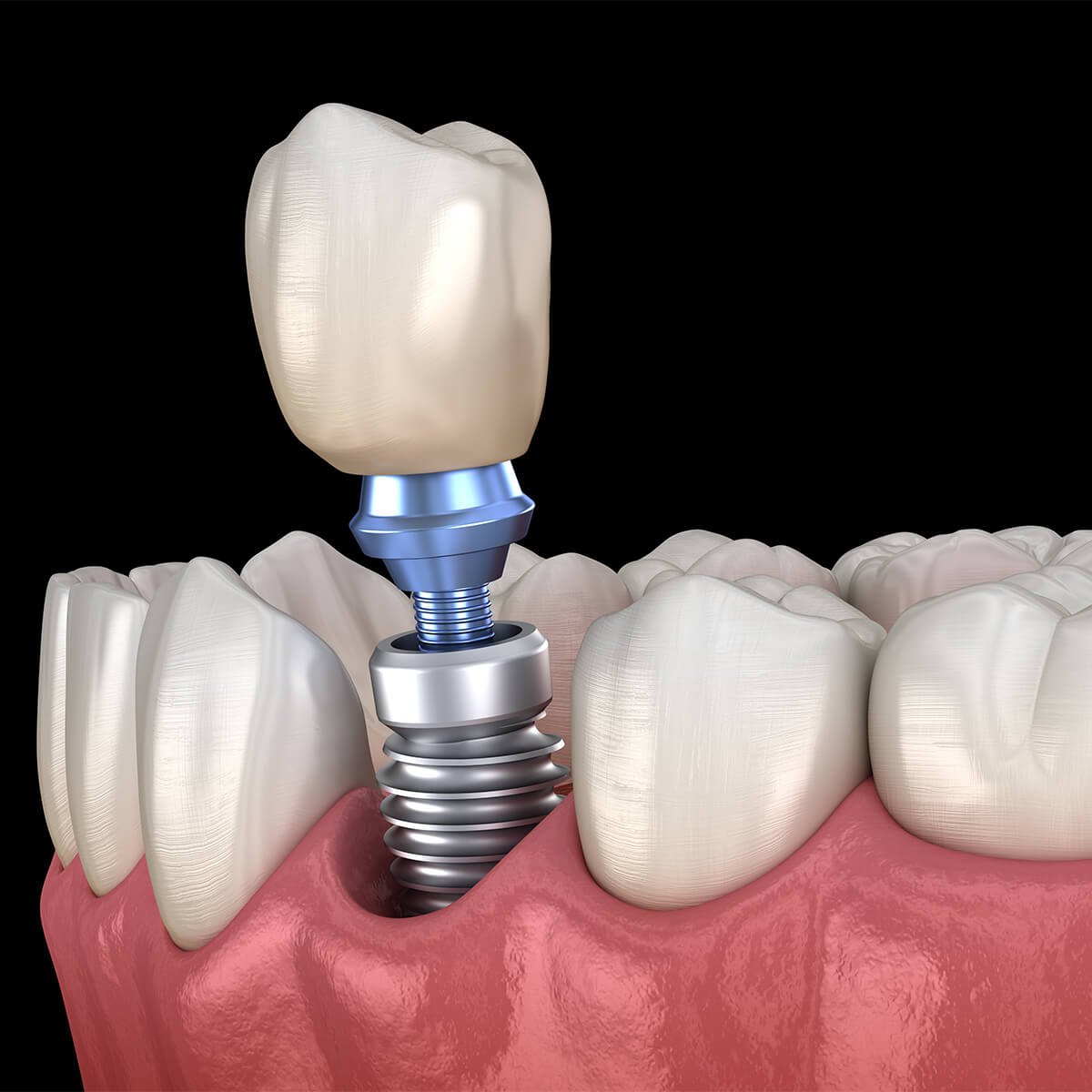 Teeth Implant Service Near Me Knoxville TN Area