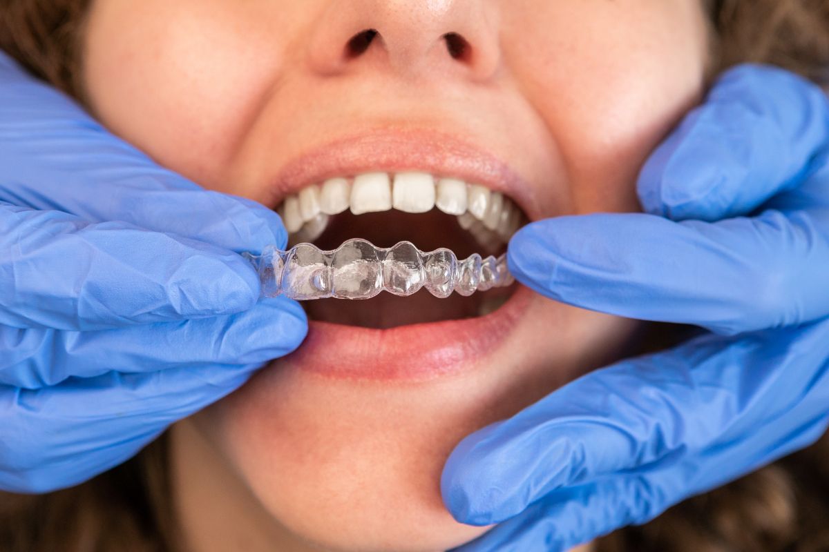 Tips for Caring for Your Teeth with Invisalign in Knoxville TN at Knoxville Smiles at Malone & Costa Dentistry