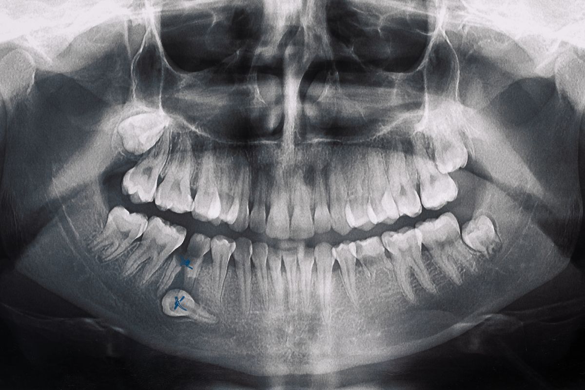 Invisalign After Bone Grafting at Knoxville Smiles at Malone
