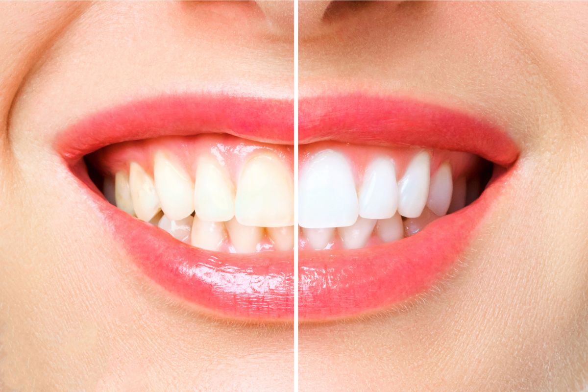 Stain Prevention After Whitening or Veneers at Knoxville Smiles at Malone & Costa Dentistry - Cosmetic Dentist