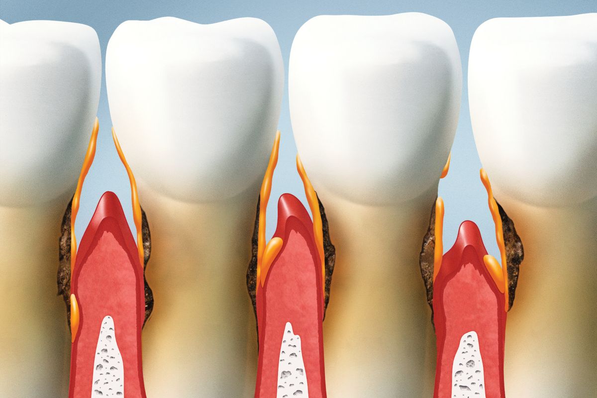 Can Gum Disease Be Cured Without Surgery at Knoxville Smiles at Malone