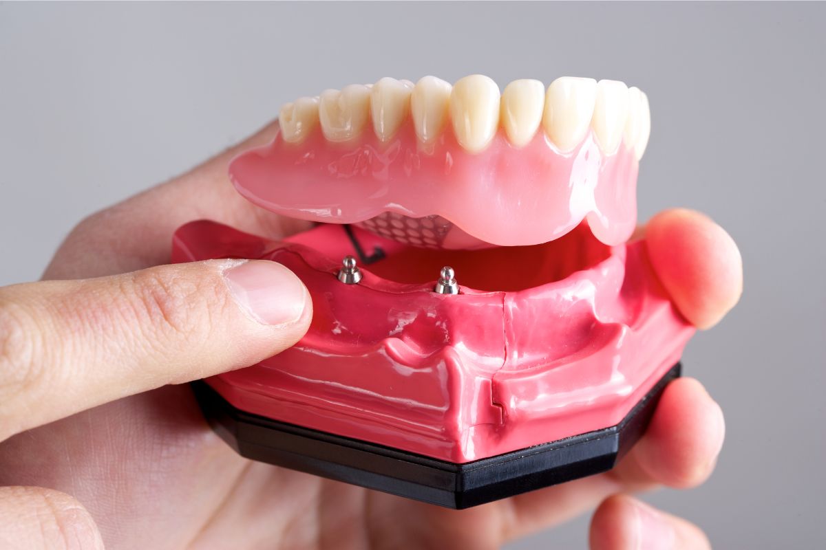 How Long Do Implant Dentures Last? - Knoxville Smiles at Malone
