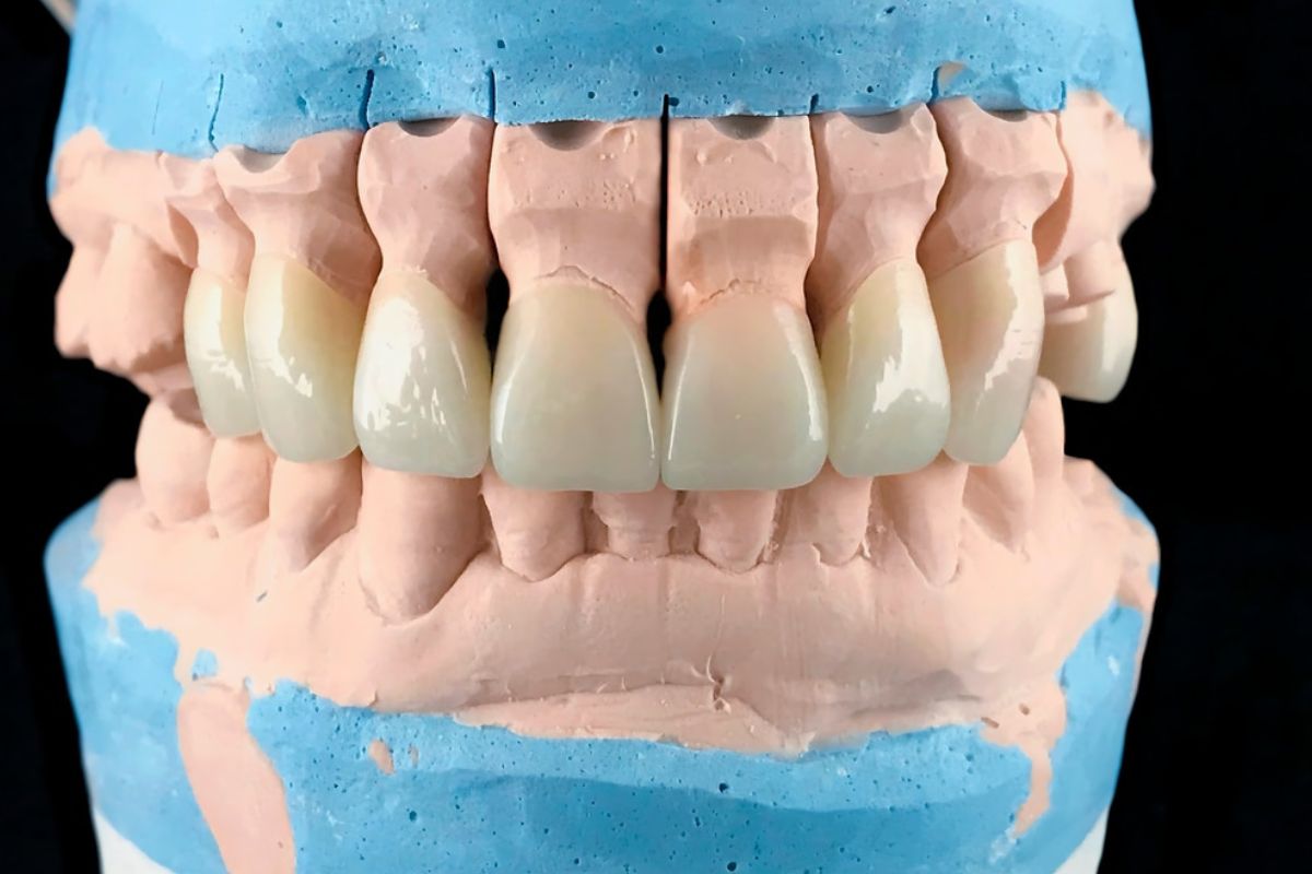 Bone Grafting & Dental Implant Solutions for Osteoporosis Patients at Knoxville Smiles at Malone & Costa Dentistry