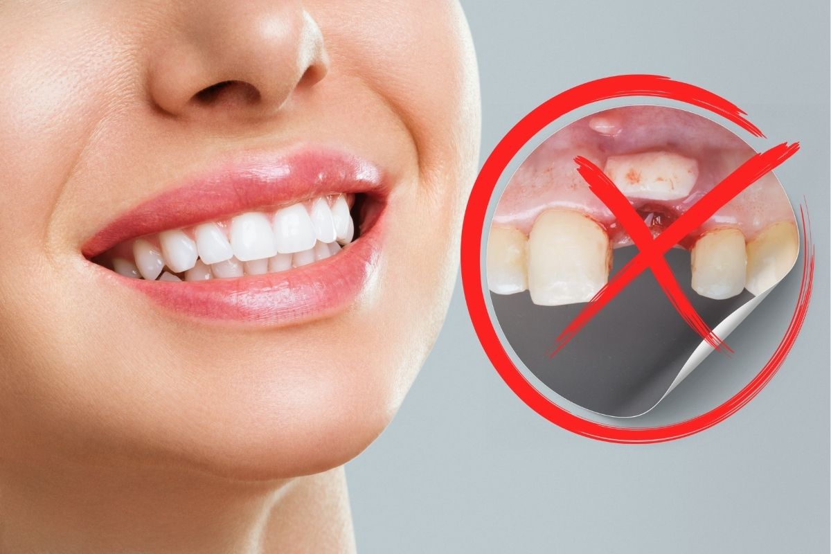 Gum Grafting in Knoxville TN at Knoxville Smiles at Malone