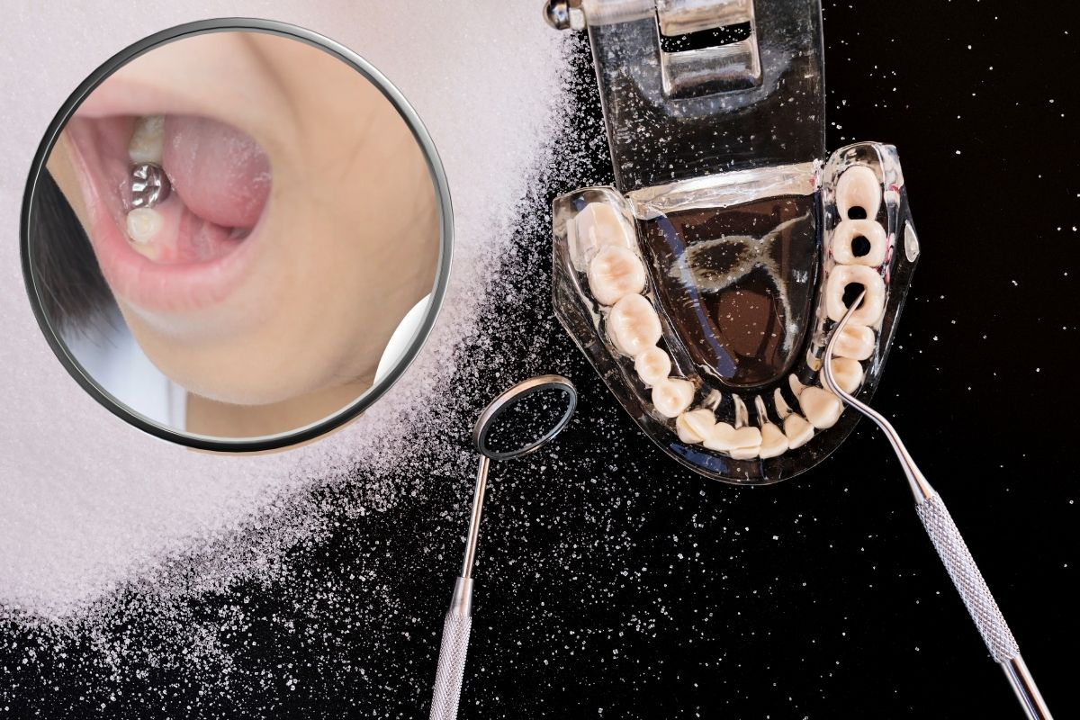 Dental Sealants Protect Deep Grooves from Decay in Knoxville TN at Knoxville Smiles at Malone