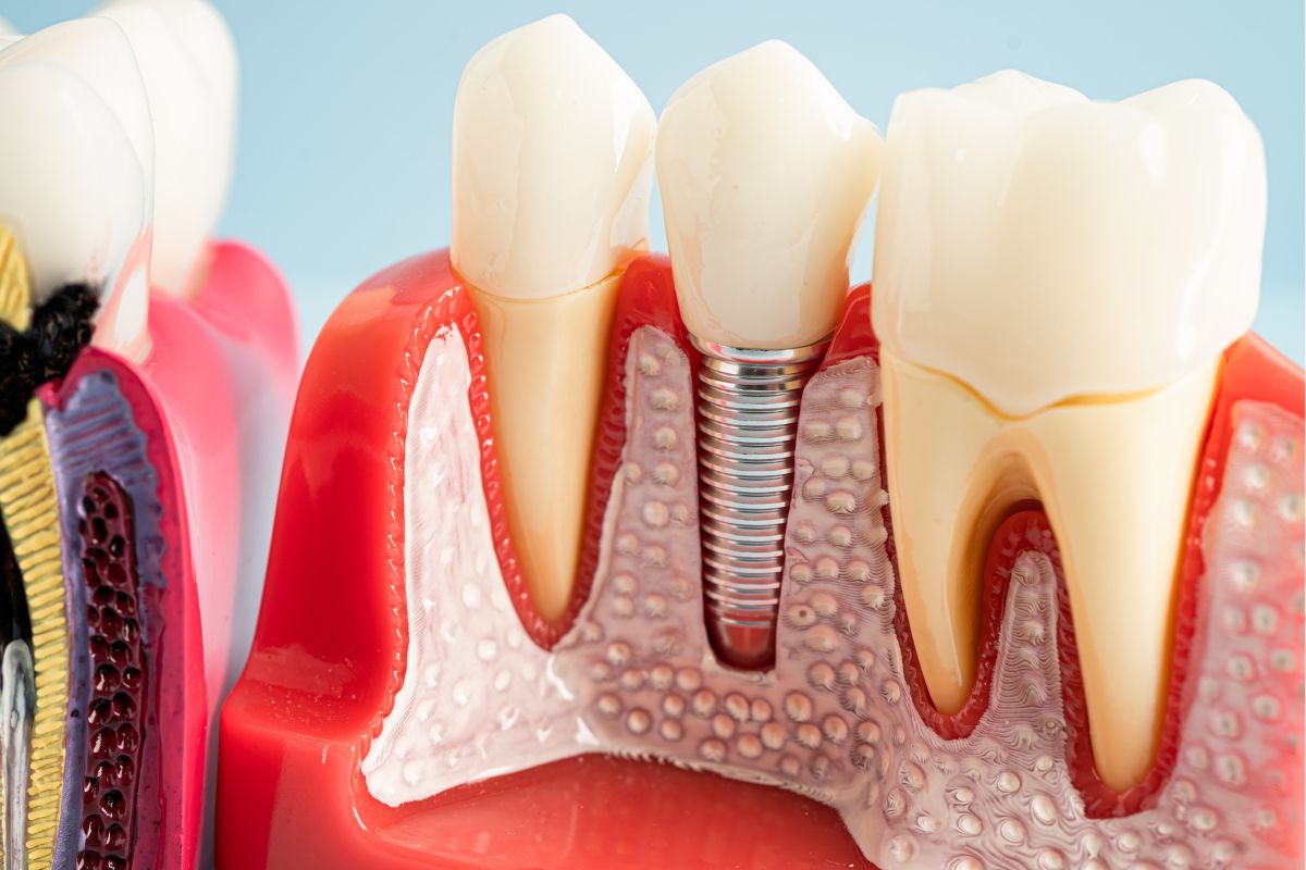 How Advanced Technology & Expertise Lead to Predictable Dental Implant