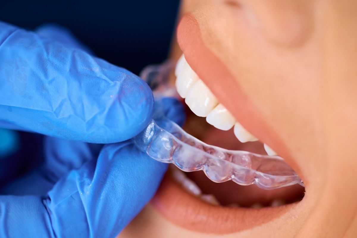 Small Gaps, Big Change: How Invisalign Helps Close Spaces Easily