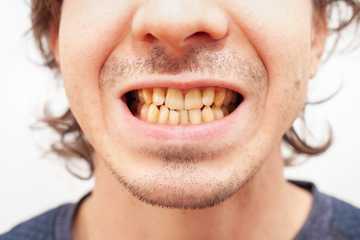 Stained Teeth