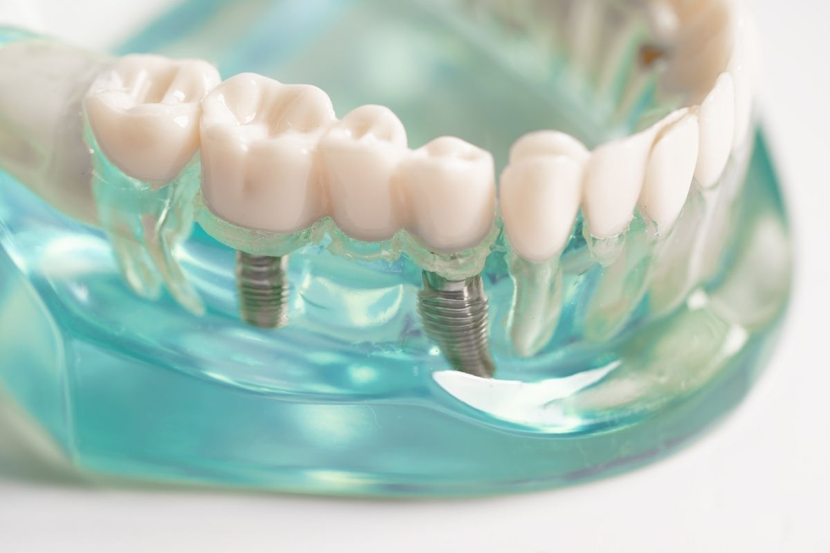 Side-by-Side Dental Implants