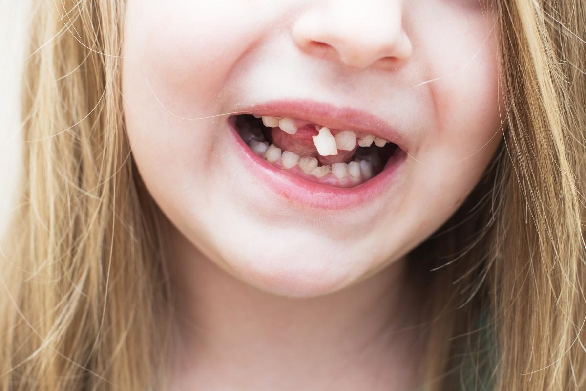 Broken Tooth
