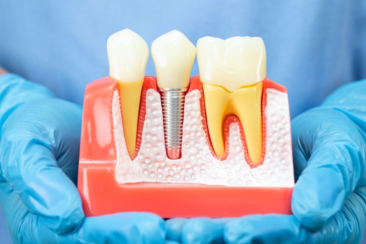 Can Dental Implants Get Cavities? The Truth You Need to Know