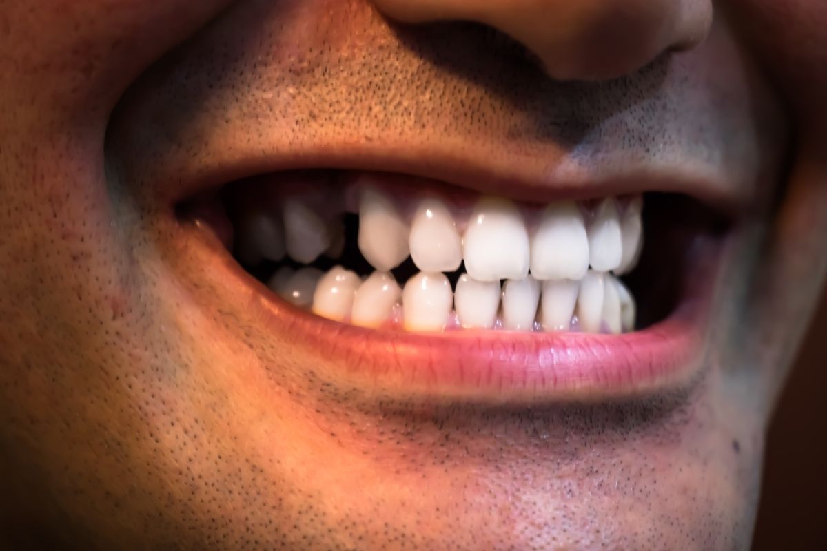 Missing Teeth Replacing