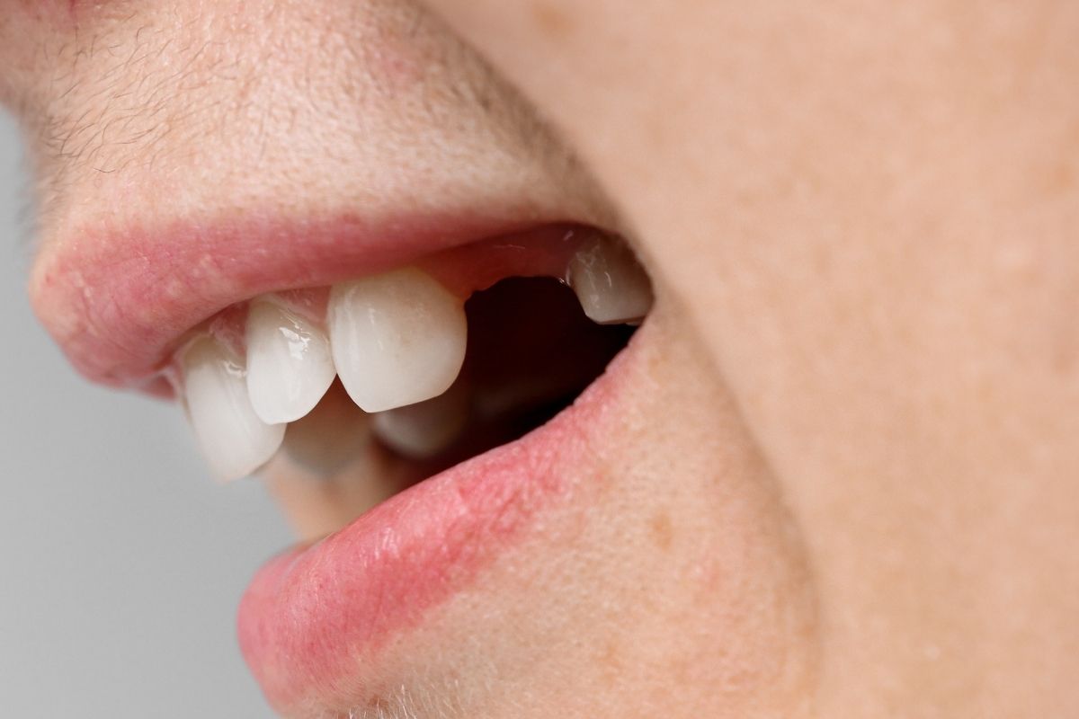 Missing Tooth