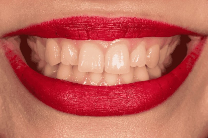 Teeth Whitening vs Veneers